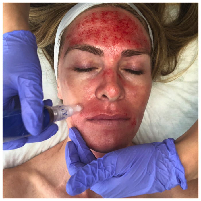 What are the Benefits of a Vampire (PRP) Facial and What Does the Procedure Look Like? (Graphic)